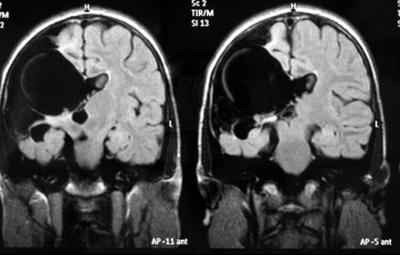 MRI of Lelah's Brain